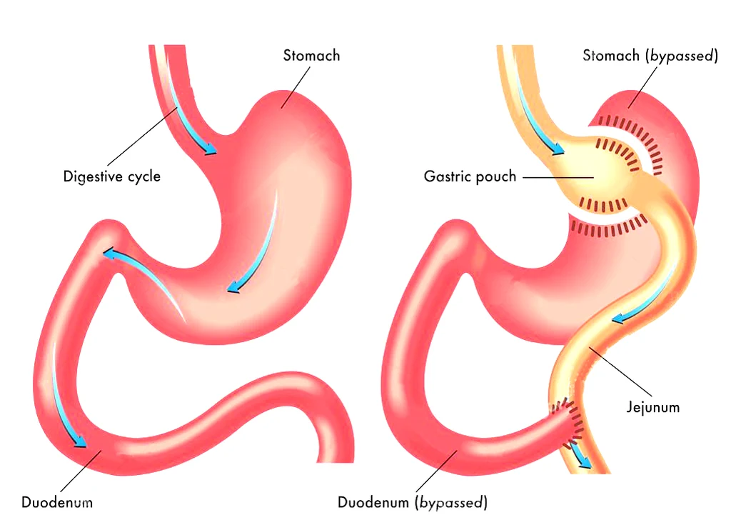 How Long Does It Take To Recover From Gastric Bypass Surgery?